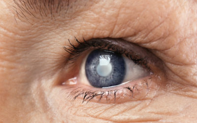 L’opération de la cataracte pourrait réduire le risque de démence